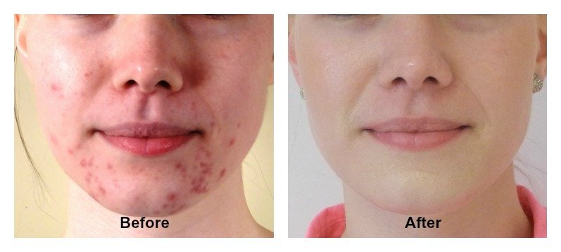 Taking Care Of Acne Prone Skin Taking Care Of Acne Prone Skin